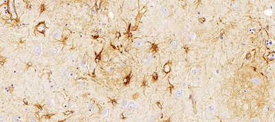 La Fundación Cien confirma la conexión entre los niveles en sangre de la GFAP y el desarrollo de Alzheimer