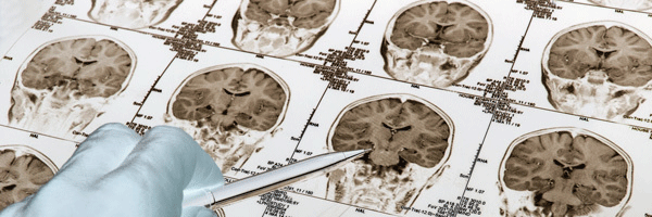 Promoción de los neurólogos jóvenes en los órganos de la SEN